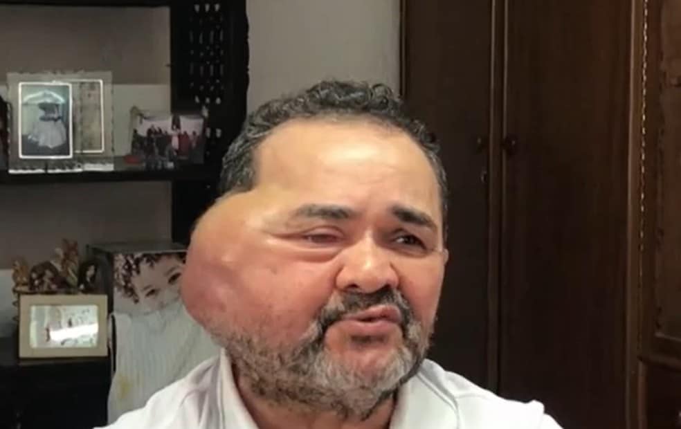 José Nilton Cardozo tem meningioma e luta para fazer cirurgia no rosto — Foto: Divulgação