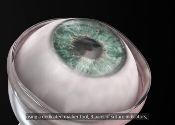 Foto: Divulgação/Córnea artificial Kpro.