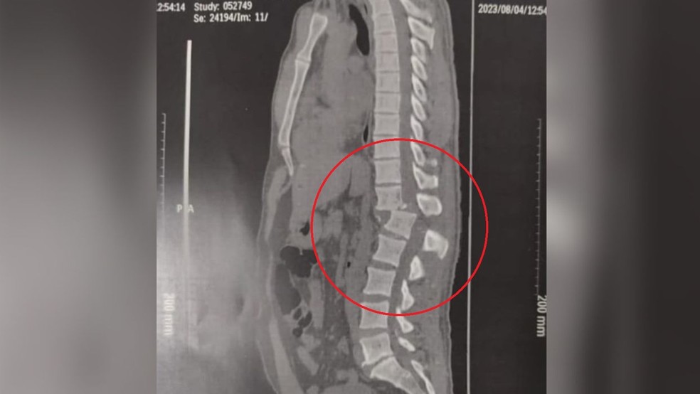 Raio-x mostra lesão na coluna de jovem lesão de jovem atingido por aparelho em academia de ginástica no Ceará — Foto: Reprodução/Arquivo pessoal