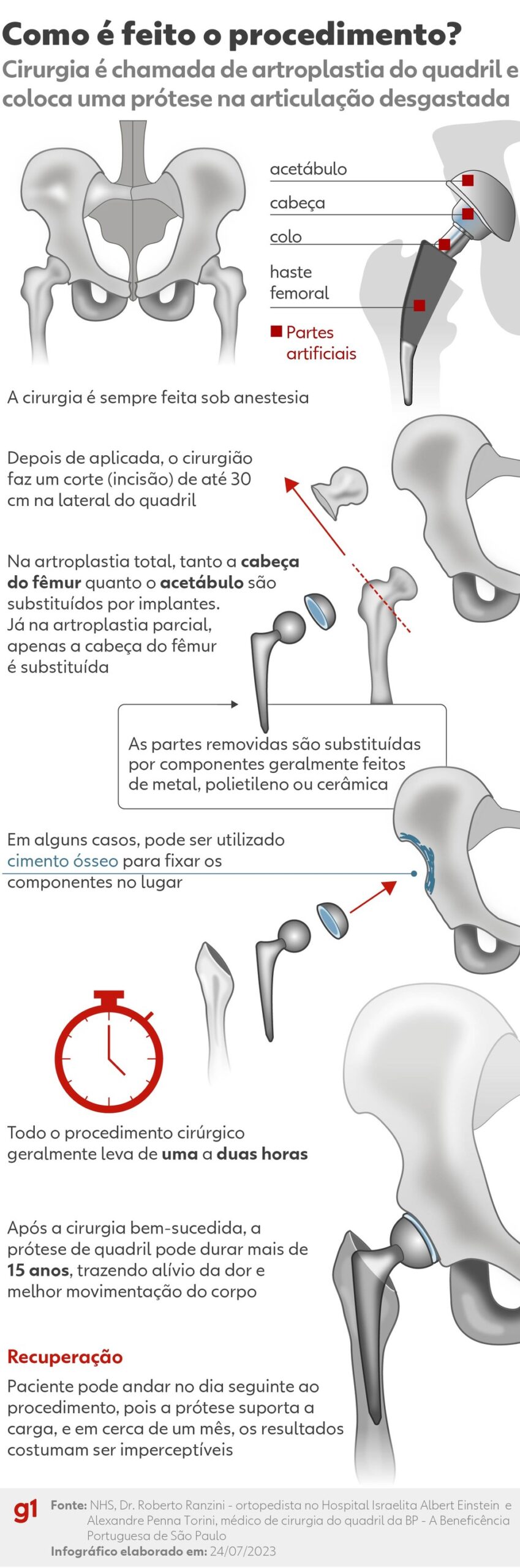 Como é o procedimento de cirurgia no quadril — Foto: Arte/g1