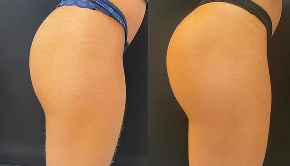 Antes e depois do bumbum de Key Alves — Foto: Reprodução/Instagram