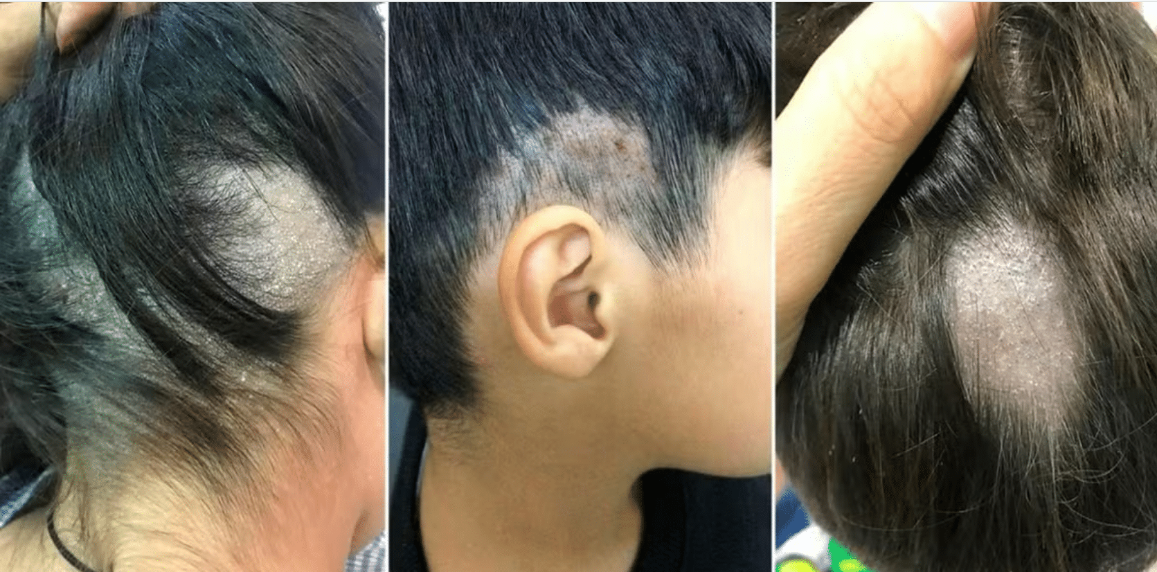 Alert: The number of cases of fungi caused by fungi transmitted in barbershops is increasing