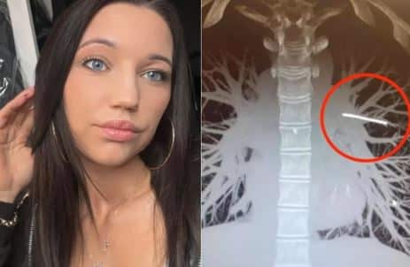 A woman goes to the doctor and panics after discovering something stuck in her lung