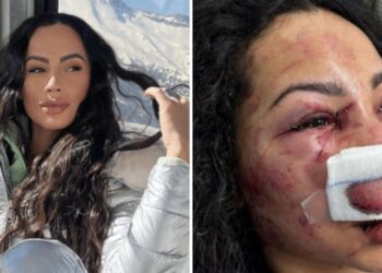 Brasileira agredida no Chile tem alta do hospital