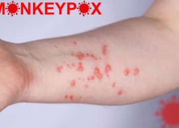 Hand of a young guy in a rash. Monkeypox virus symptoms.