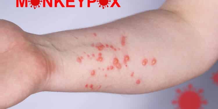 Hand of a young guy in a rash. Monkeypox virus symptoms.