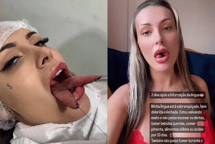 Andressa Urach decide fazer novo procedimento após bifurcar a língua