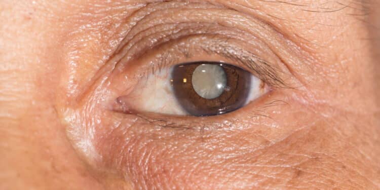 Close up of the mature cataract during eye examination.