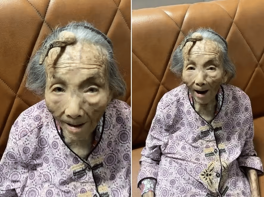 Idosa de 107 anos surpreende e viraliza com 'chifre' crescendo na testa; VEJA