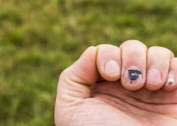 Unhas fracas ou quebradiças? Conheça os sinais que podem revelar sérios problemas de saúde