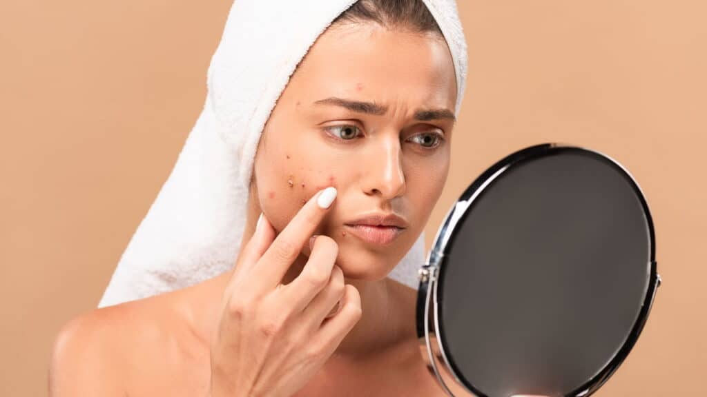 Acne zero! Aprenda a cuidar da sua pele da maneira correta para prevenir acne