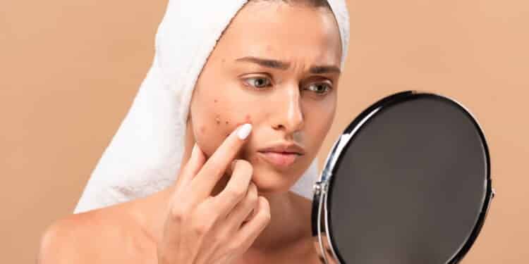 O segredo que ninguém te contou para sumir com a ACNE!