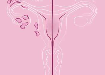 Endometriose tem ligação com traumas? Estudo revela descoberta preocupante!