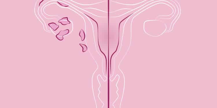 Endometriose tem ligação com traumas? Estudo revela descoberta preocupante!