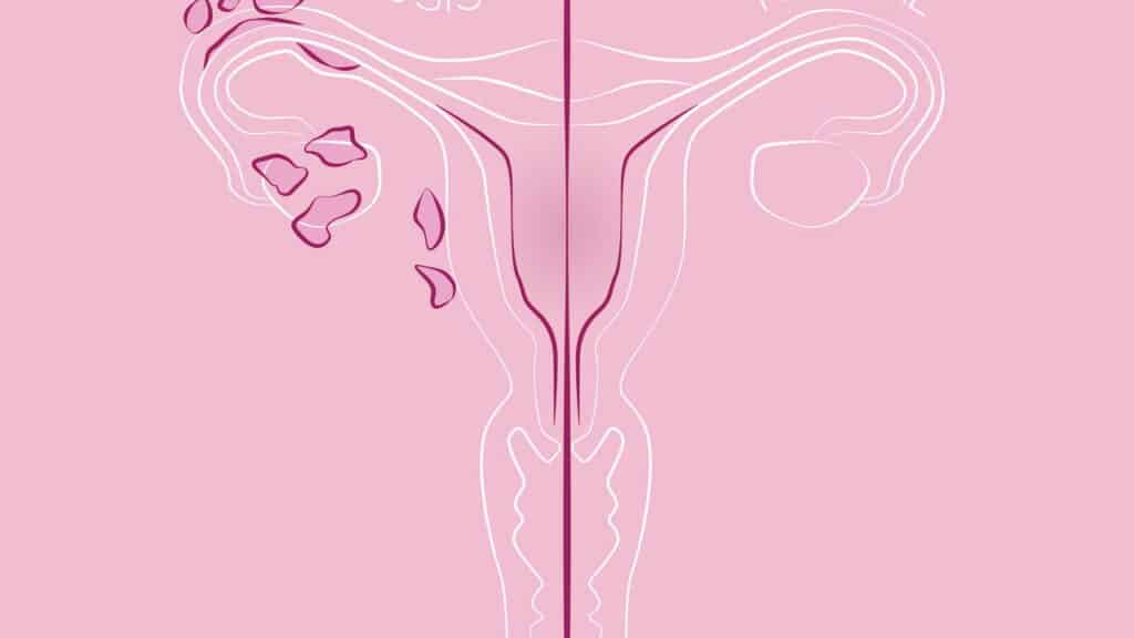 Os sinais mais perigosos da endometriose que ninguém te conta