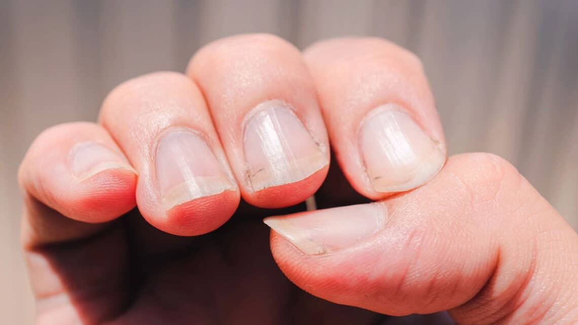 Ter unhas claras e esbranquiçadas pode ser um mal sinal! - Terra Brasil ...