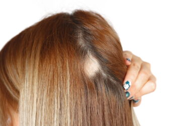 Alopecia, um problemas que muitas mulheres sofrem e poucas falam.