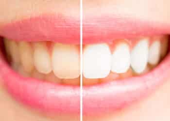 Você faz isso? Hábitos comuns que arruinam seus dentes; saiba como evitar e as melhores práticas