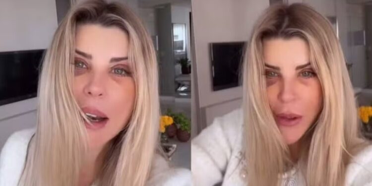Ex-BBB Íris Stefanelli aparece com hematomas no rosto e gera preocupação nos fãs