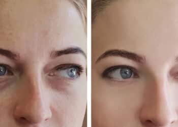 Esse tratamento natural é a melhor maneira de tratar os pés de galinha!