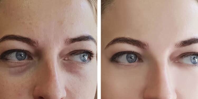 Esse tratamento natural é a melhor maneira de tratar os pés de galinha!