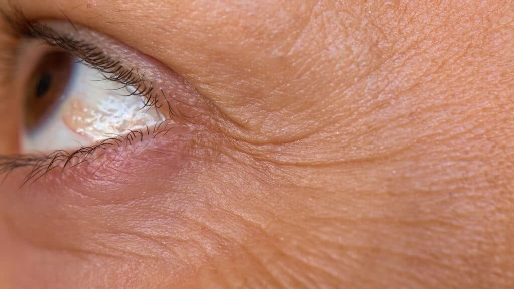 Esse tratamento natural é a melhor maneira de tratar os pés de galinha!
