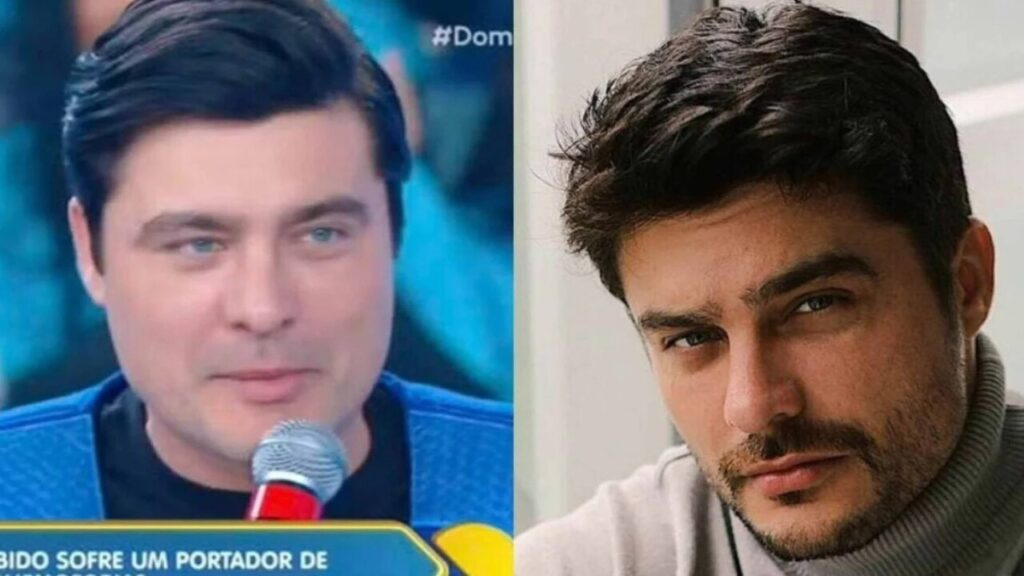 Ex-galã da Globo surge irreconhecível após harmonização facial e choca fãs; veja antes e depois