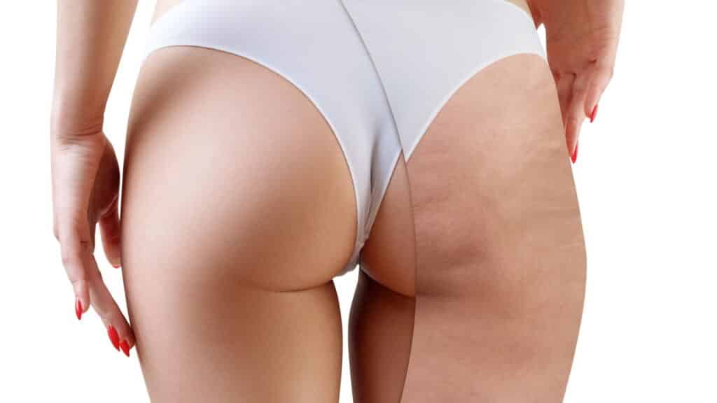 Diga adeus para para celulite, top 4 cremes firmadores que acabam com as marcas nas pernas e bunda