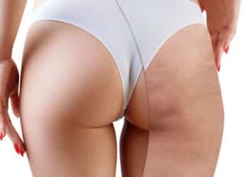 Adeus celulite com desconforto: Novas faixas frias que desincham e modelam sem sofrimento!