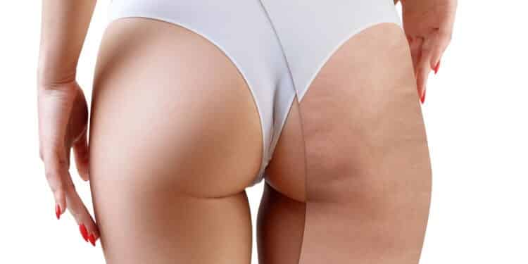 Adeus celulite com desconforto: Novas faixas frias que desincham e modelam sem sofrimento!