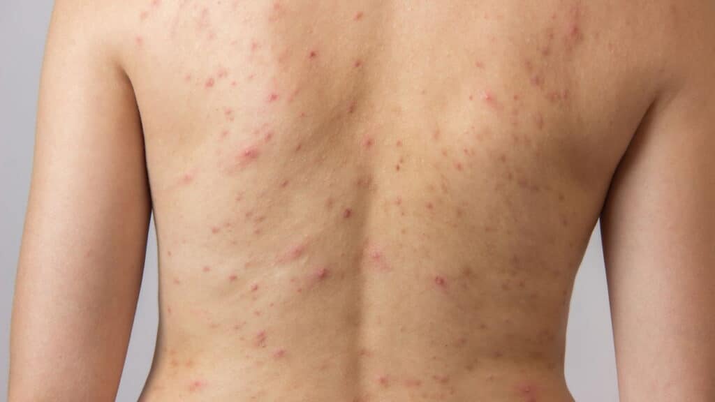 Acne nas costas - Créditos: depositphotos.com / Vox19