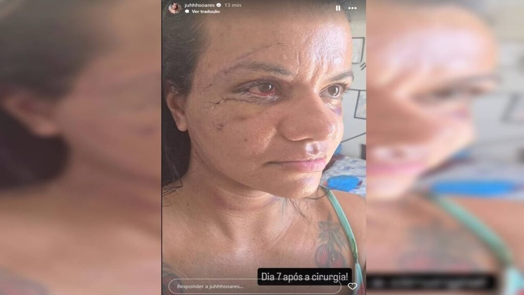 Caso Juliana: mulher agredida com 61 socos mostra o rosto poucos dias depois de cirurgia; veja