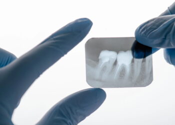 Menino tem 526 dentes removidos em cirurgia e caso raro surpreende