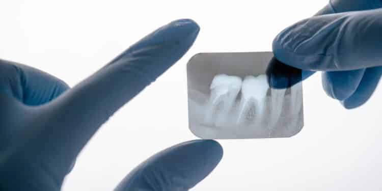 Menino tem 526 dentes removidos em cirurgia e caso raro surpreende