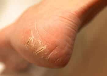 Veja como acabar com os pés ressecados e conquistar 'pés de seda' de forma simples