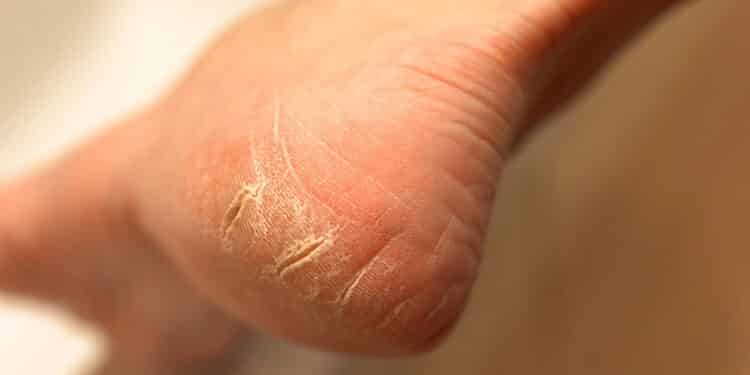 Veja como acabar com os pés ressecados e conquistar 'pés de seda' de forma simples