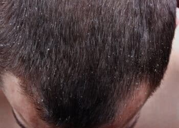 Adeus caspa, este shampoo baratinho resolve já no primeiro uso