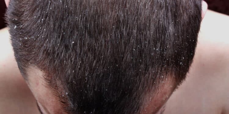 Adeus caspa, este shampoo baratinho resolve já no primeiro uso