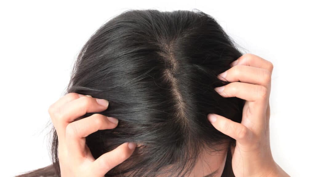 Adeus caspa, este shampoo baratinho resolve já no primeiro uso