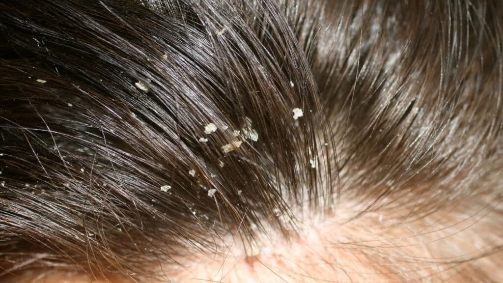 Adeus caspa e vergonha, 7 shampoos profissionais que transformam o couro cabeludo