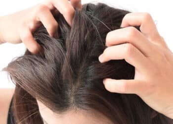 Como evitar descamação no couro cabeludo em casa de forma natural
