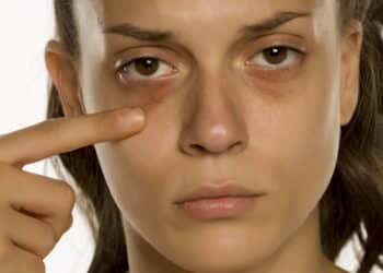 Dicas caseiras para aliviar olheiras profundas no dia a dia