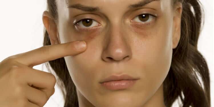 Dicas caseiras para aliviar olheiras profundas no dia a dia