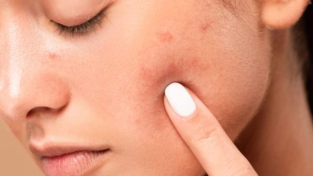 Diga adeus as manchas escuras na pele, o melhor jeito de tratar e prevenir foi descoberto