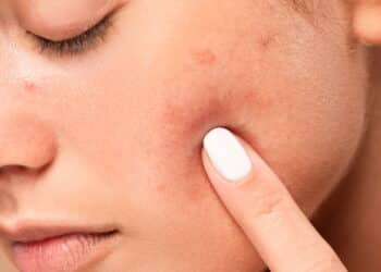 Diga adeus as manchas escuras na pele, o melhor jeito de tratar e prevenir foi descoberto