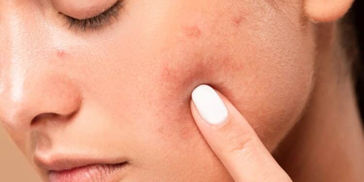 O melhor tratamento para manchas na pele segundo dermatologistas