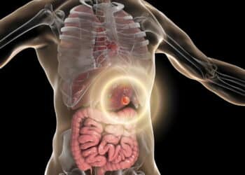 Mudanças simples reduzem em 30% o risco de câncer de intestino