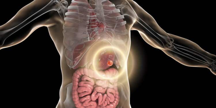 Mudanças simples reduzem em 30% o risco de câncer de intestino