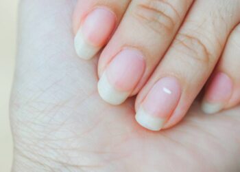 Essas pequenas manchas brancas nas unhas podem revelar muito sobre sua saúde
