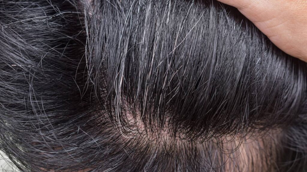 Você não vai acreditar nos benefícios de usar vinagre e bicarbonato de sódio nos cabelos grisalhos